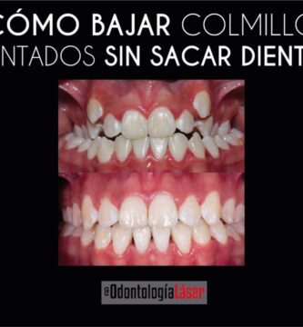 Soluciones efectivas para una dentadura sin colmillos brillante